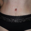 Belly button a bit red around the edges but now dry and healing well. I did not have a belly button before at all (check out my before photos, it was lost in a mound of old scars and was hideous)