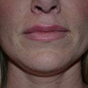14 days after surgery