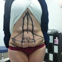 Pre-tummy tuck surgical markings