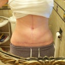 8 months post-op