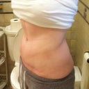 8 months post-op
