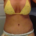 2 weeks post op