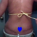 2 weeks post op