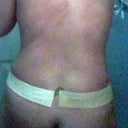 1 month post op starting the new gel silocone tape