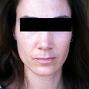 A few months later.  I have to admit that I haven't been using sunblock religiously, so some pigmentation has come back, but my skin still remains a lot better!