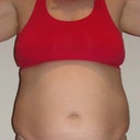 Before (day of surgery)