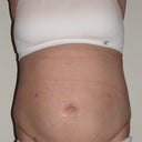 After (day 10 post-op)