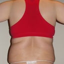 Before (day of surgery)