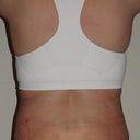 After (day 10 post-op)