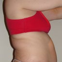 Before (day of surgery)