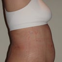 After (day 10 post-op)