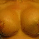 Post-op 15 days, steri-stips off, right one has some superficial scabing and left one still swollen, all in all they look prety good at this stage :)