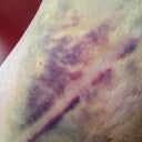 PO Day 10-This is the bruise on my inner thigh from the lipo. The other leg isn't nearly as bad.
