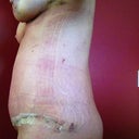 PO Day 10-Side view: Swelling is really evident. The good news is I feel fine.