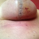 PO Day 10-My attempt to capture my boob incisions. I was glad they didn't have to cut around my areola. My breasts have not bothered me at all so far. Knock on wood!