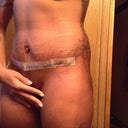 Post op 9 :) swollen but I'm ok with it