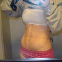 5 weeks post op, look at those abs!