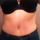 8 1/2 week post op in jeans