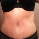 8 1/2 weeks post op panties