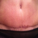 8 1/2 week post op scar