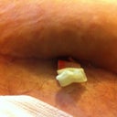 my wound with the packing sticking out