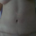 5.5 months post-op
