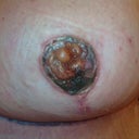 This is a picture of my then dying nipple and areola. The bubbles you see are blistering of the area.