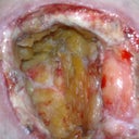 This was taken after dying and rotting fat was removed. She would cut out all of the fat and pack me full of saline soaked gauze. Fat has been removed every week.
