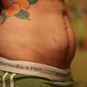 night before TT and scar revision - double butt