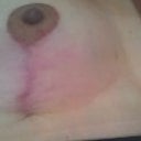 Right breast scar
