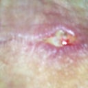 Open area stiches were protruding had to be snipped out so it would heal. Can't re-close it cause of bacteria concerns. Oh well just be a wider part of the scar. Not upset by it, still looking damn good!