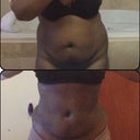 Had stomach lipo. Wasnt really pressed for a super flat tummy and my pre mom belly is retracting a bit. Back, sides and stomach still swollen. 3 weeks po