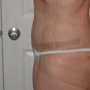 16 days post op