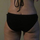 PO 24 days 
Vaser Hips flanks : (