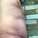 6 months post-op