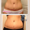 Revisiting Scar therapy. I think there is a noticeable difference. This is less than 2 weeks of therapy.