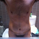 Post Op - Day 3 - Hunched, swollen and my new belly button! Just after a shower.