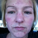 This is about 15 minutes after the treatment