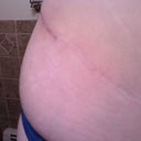 right side upclose scar revision to end. revision on december 2011 picture february 2012