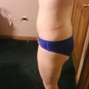 left side with scar revision to the end revison made december 2011 picture February 2012