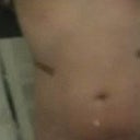Lip-o a month post op.