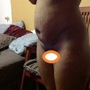 B4-Pic 2 Stretch marks