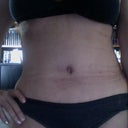 3.5 weeks PostOp.  My undies feel tighter than usual.  With all the bloating I can see a slight difference between my before and after pics. The marks on my stomach are from the compression garment I wear 24/7.
