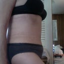 Side view 3.5 weeks PostOp.  Still very bloated and swollen between belly button and pubic area.