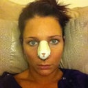 Day 3, day of internal splint removal.