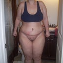 post op day 8. swelling and my BB looks funny but not really concerned with it.