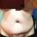 You can see some of the dressing still on the left side. I am swollen. This is late afternoon.