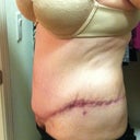 Left side. I know the scars are rough on me but I don't really stress over them. They will fade.