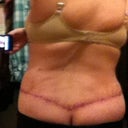 My "whale tail" as my hubby calls it. The numbness is getting a little better.