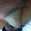 Right Breast